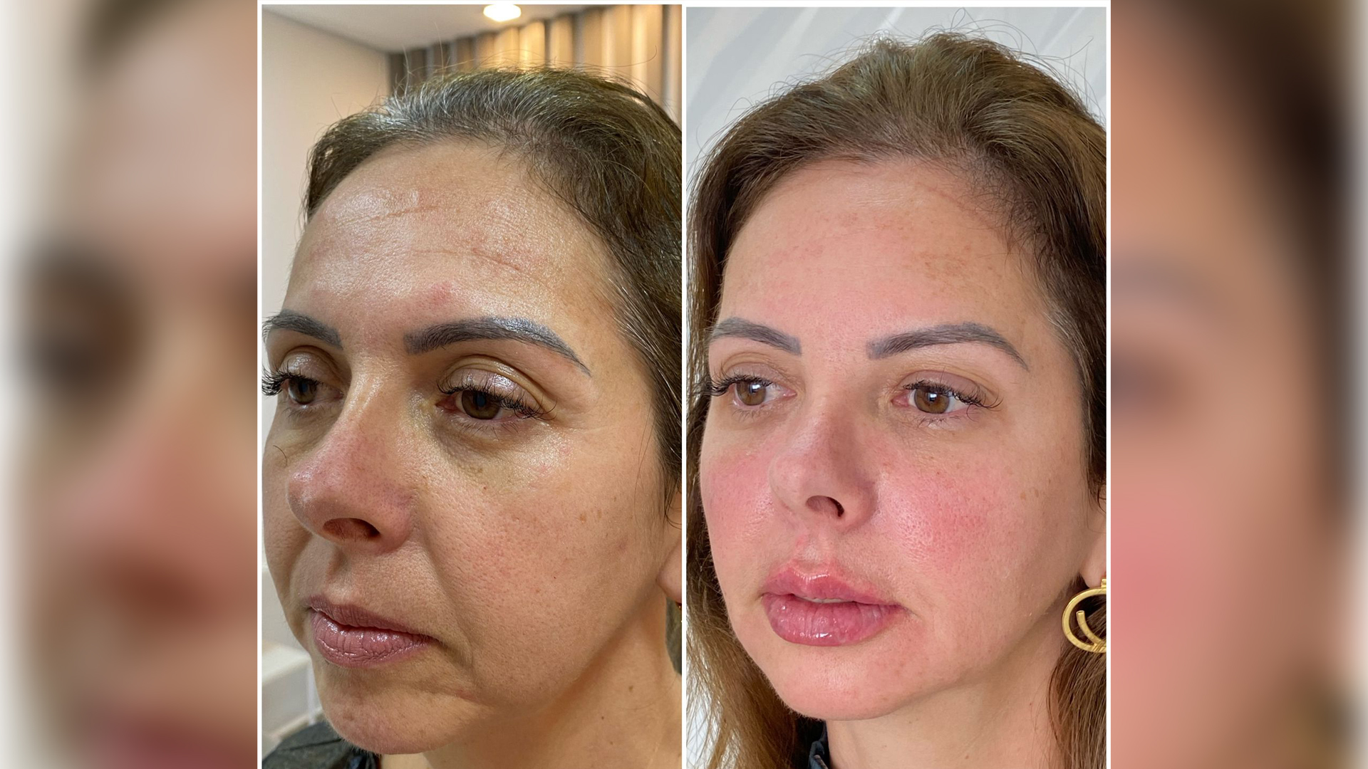 Adeus ao “ar cansado”: preenchimento de olheiras vira febre em 2026 e promete rejuvenescimento imediato